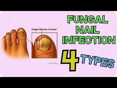 4 TYPES OF FUNGAL NAIL INFECTIONS YOU MAY HAVE (TOENAIL FUNGUS) - YouTube