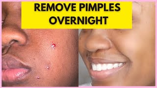 HOW TO REMOVE PIMPLES OVERNIGHT | ACNE TREATMENT