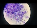 Cytology interpretation - likely uterine adenocarcinoma from a hamster