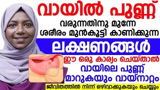 വായിൽ പുണ്ണ് വരുന്നതിന്റെ മുമ്പ് ശരീരം കാണിച്ചു തരുന്ന ലക്ഷണങ്ങൾ ഇതാണ്