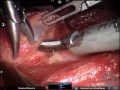 dr. babu manohar robotic assisted thyroidectomy edited ver.