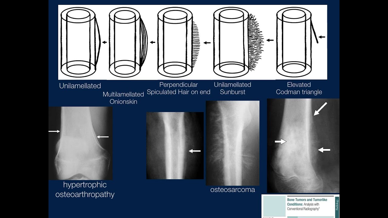 Bone Lesions: Radiographic Assessment, Part 1, By Geoffrey Riley, MD ...