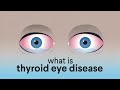 What is Thyroid Eye Disease (TED)?