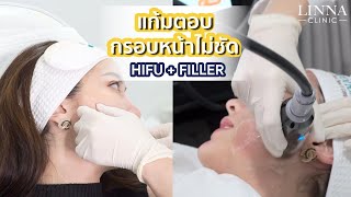 'ยกกระชับ และปรับรูปหน้า' ด้วย HIFU \u0026 FILLER แก้มตอบ