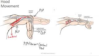 extensor hood and finger deformities