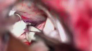 Trigeminal neuralgia surgery by Dr. kalpesh Shah neurosurgeon Zydus Hospital Ahmedabad