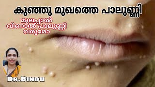 പാലുണ്ണി/മുലപ്പാൽ വീണത് കൊണ്ട് വന്നതാണോ/Molluscum/Babycare tips Dr Bindu