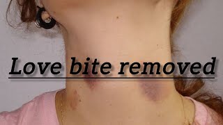 how to remove hickey / love bite removed / how to hide love bite