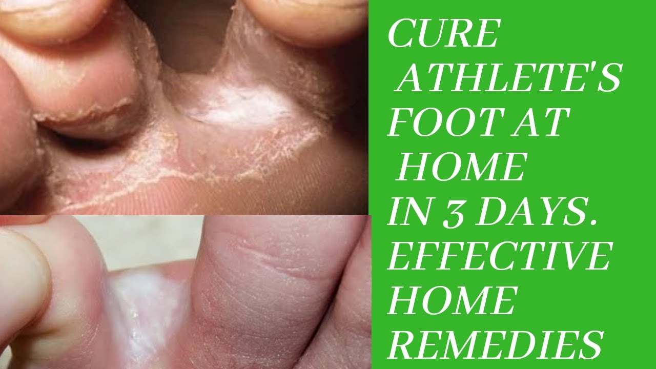 HOW TO PREVENT & CURE ATHLETE'S FOOT OR FOOT FUNGUS & TOE NAIL FUNGUS ...