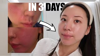 How to Calm Your Skin in Just 3 Days(No Cost | At Home Care)