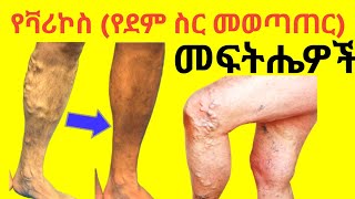 How To Get Rid Of Varicose Veins (4 Solutions)የደም ስር መወጣጠር መፍትሄዎች