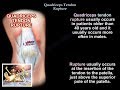 Quadriceps Tendon Rupture  - Everything You Need To Know - Dr. Nabil Ebraheim