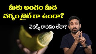 అం_గం మీద చర్మం టైట్ గా ఉందా? వెనక్కి రావడంలేదా? Phimosis Treatment Telugu | Dr.Surendra Reddy