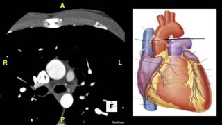 Axial CT Heart