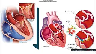 Infective Endocarditis ( IE )