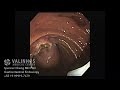 endoscopic management of tumor of the major duodenal papilla part 2