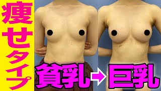 【豊胸】痩せ型で胸の大きさに悩んでいる方2カップUP！貧乳から理想の胸を実現【巨乳】