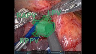 Robotic dissection of portal vein trifurcation during hepatectomy