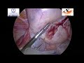 OVARIAN DERMOID CYST EXCISION IN ENDOBAG