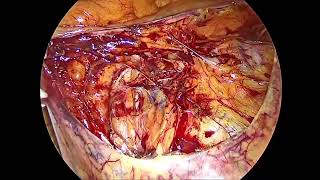 Laparoscopic Retroperitoneal Anatomy Voice 2024 Advanced Female Pelvic Radical Surgery Ilker SELCUK