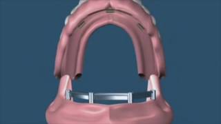 Iperdent - Overdenture, protesi rimovibile su 4 impianti