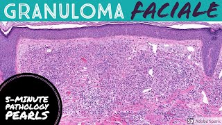 Granuloma Faciale: 5-Minute Pathology Pearls