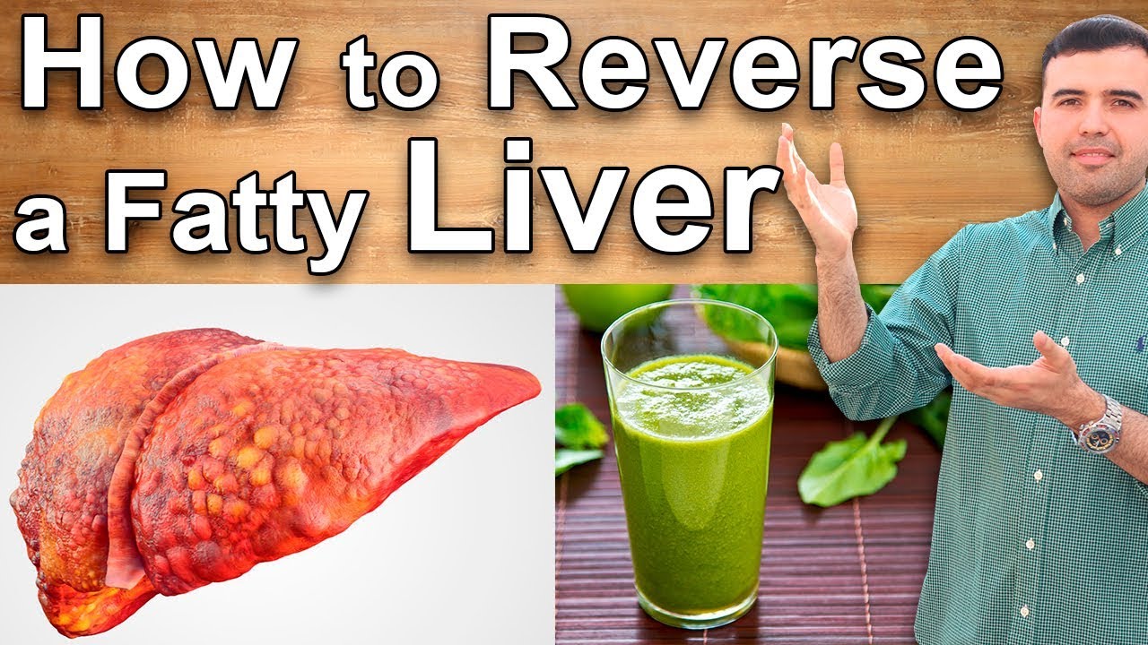 Fatty Liver Treatment