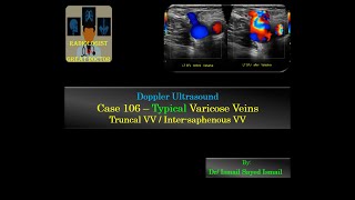 Ultrasound Case 106 - Typical Varicose Veins / Truncal VV