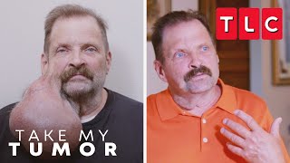 Tim Is Unrecognizable After His Tumor Removal | Take My Tumor | TLC