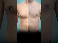 🥰joyful gynecomastia results male breast removal 360° 4dx surgery shortsfeed