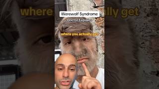 Werewolf Syndrome - Doctor Explains #shorts