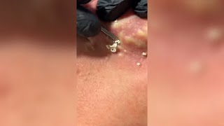 Popping huge blackheads and Pimple Popping - Best Pimple Popping Videos 187