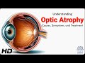 Optic Atrophy Explained: Causes, Symptoms, and Treatment Options