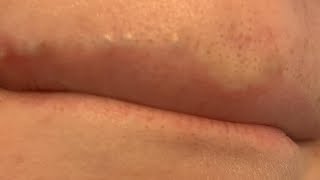 how to get rid of blackheads on lip line fast