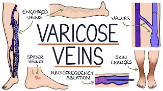 Understanding Varicose Veins