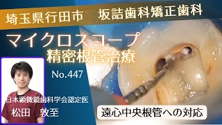 447.羽生市加須市根管治療マイクロスコープ坂詰歯科　DM根管