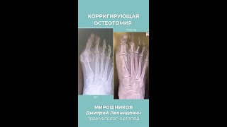 Корригирующая остеотомия