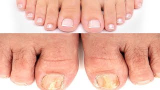 Fungal Nail Infection | 3 Simple Home Remedies to get rid of Toenail Fungus | Instant Relief |