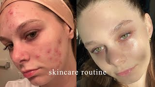 the skincare routine that FINALLY cleared my acne