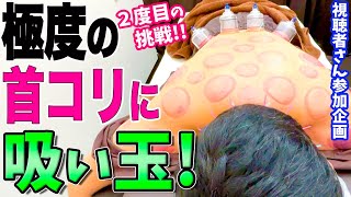 【吸い玉】重症患者さんに2度目の吸い玉！極度の首コリに鍼灸師が吸い玉と鍼で再度挑みます【カッピング】