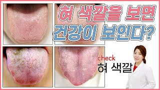 혀 색깔로 건강진단 하는 방법