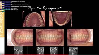 T-scan и Клиновидные дефекты. Фрагмент вебинара по работе с Т-скан от 10 июля 2018