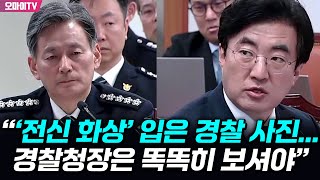 ‘전신 화상’ 경찰 간부, 목숨 끊으려고 했던 이유가···“직속상관의 직장 내 괴롭힘”