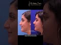 what is hispanic rhinoplasty