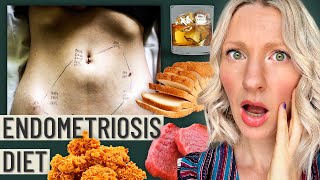 The Truth About The Endometriosis Diet (This is your warning sign)
