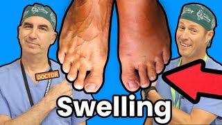 Foot and Ankle Swelling: What Causes It?