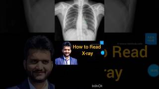 chest x-ray #what is normal x ray #shorts #medical #how to read x-ray