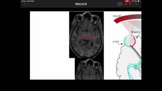 Training 9: Imaging anatomy of the optic nerve and visual pathway