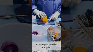 Micro Vascular Graft Bone Preparation Technique