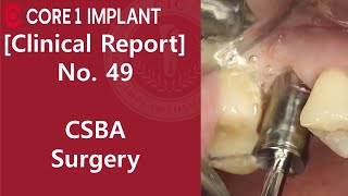 [CYBERMED Clinical Report] #16 implant placement with Crestal Sinus Bone Augmentation